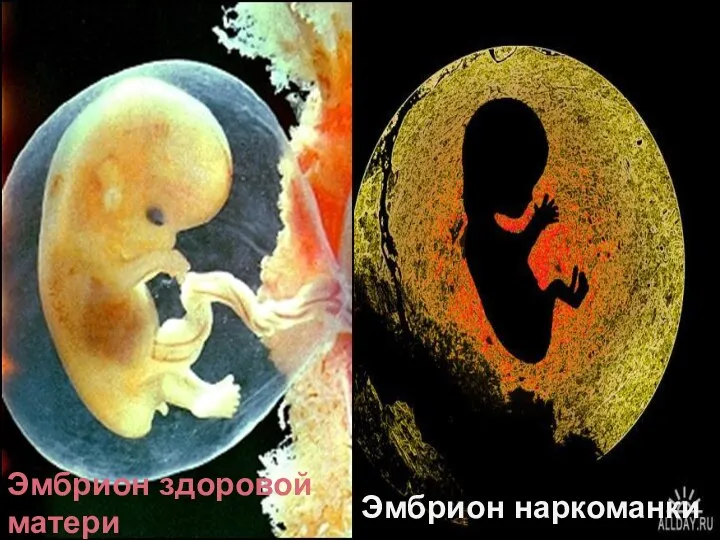 Эмбрион здоровой матери Эмбрион наркоманки Эмбрион здоровой матери