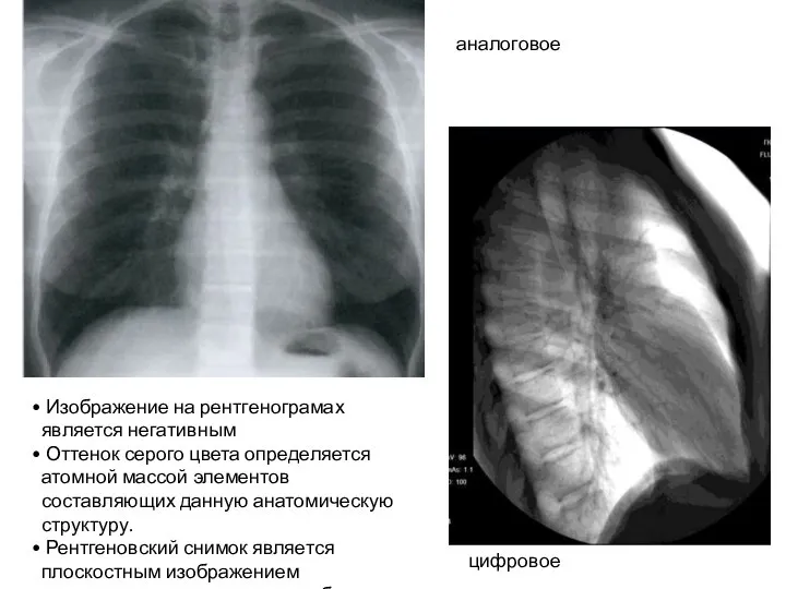 Изображение на рентгенограмах является негативным Оттенок серого цвета определяется атомной массой элементов