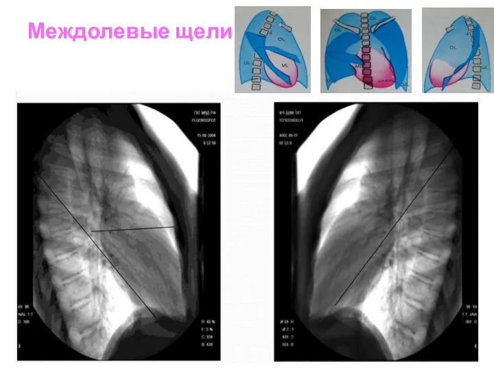 Междолевые щели