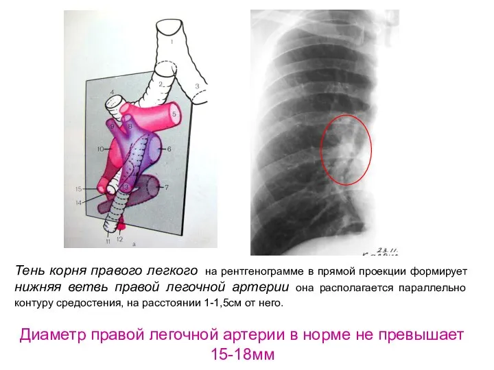 Тень корня правого легкого на рентгенограмме в прямой проекции формирует нижняя ветвь