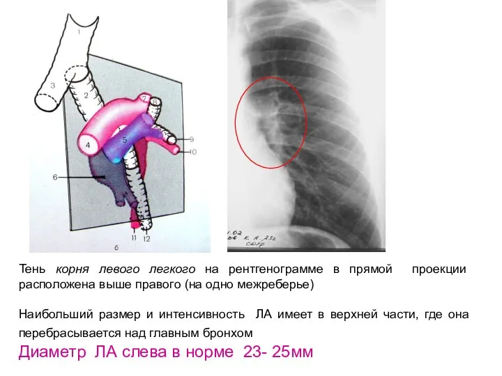 Тень корня левого легкого на рентгенограмме в прямой проекции расположена выше правого