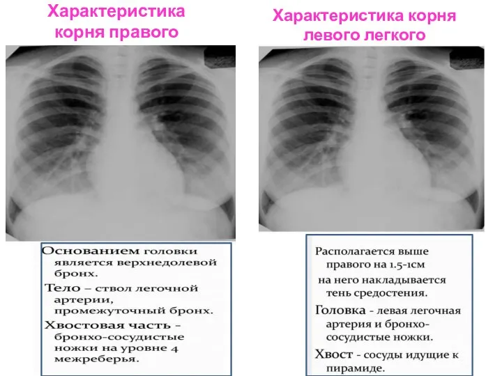 Характеристика корня правого легкого Характеристика корня левого легкого