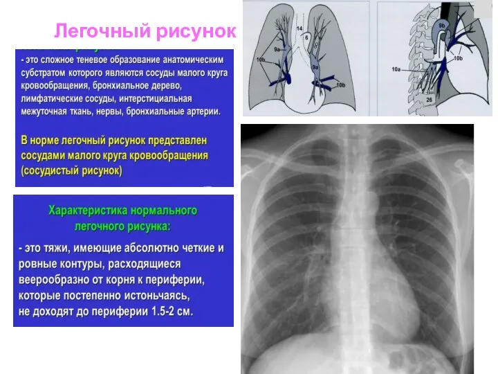 Легочный рисунок