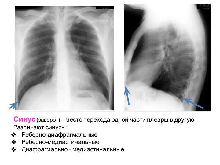 Синус (заворот) – место перехода одной части плевры в другую Различают синусы: