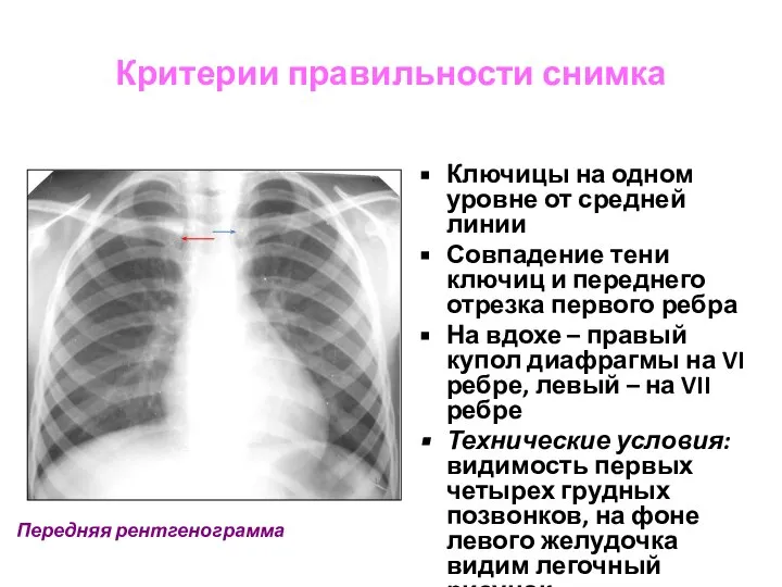 Критерии правильности снимка Ключицы на одном уровне от средней линии Совпадение тени