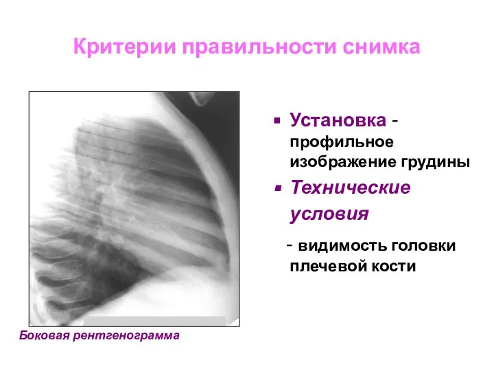 Критерии правильности снимка Установка -профильное изображение грудины Технические условия - видимость головки плечевой кости Боковая рентгенограмма