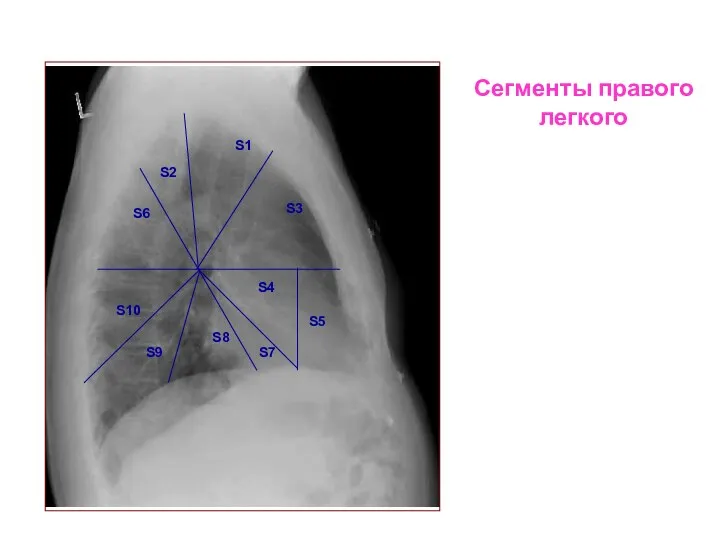 Сегменты правого легкого S4 S5 S7 S8 S9 S10 S6 S2 S1 S3