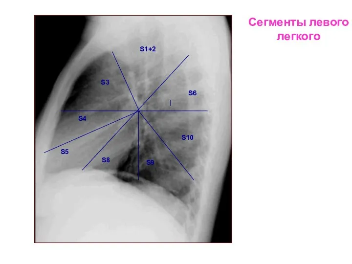 Сегменты левого легкого S1+2 S3 S4 S8 S5 S9 S6 S10