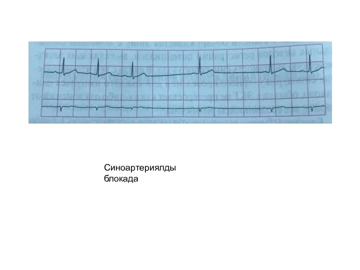 Синоартериялды блокада