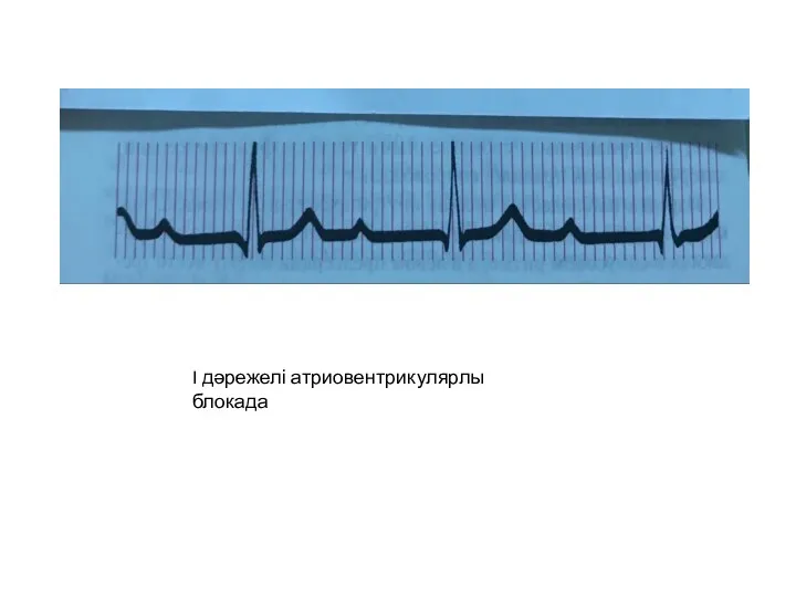 I дәрежелі атриовентрикулярлы блокада