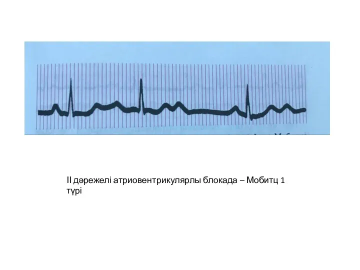 ІІ дәрежелі атриовентрикулярлы блокада – Мобитц 1 түрі