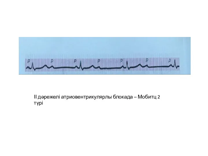 ІІ дәрежелі атриовентрикулярлы блокада – Мобитц 2 түрі