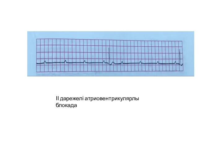 ІІ дәрежелі атриовентрикулярлы блокада