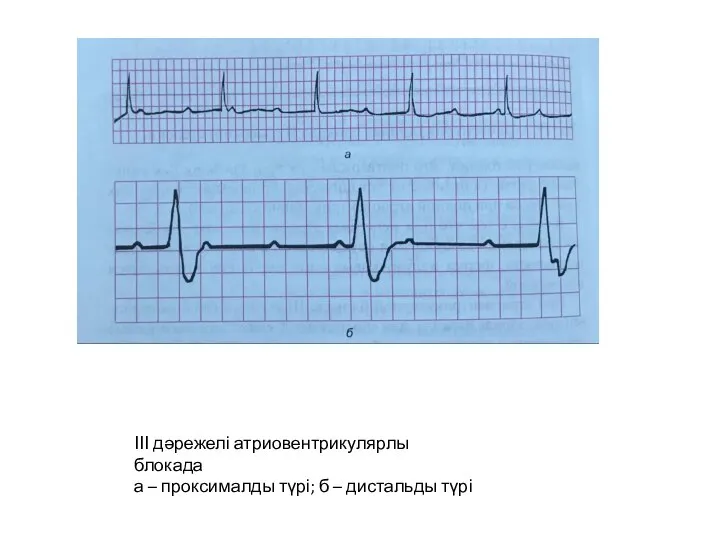 ІІІ дәрежелі атриовентрикулярлы блокада а – проксималды түрі; б – дистальды түрі