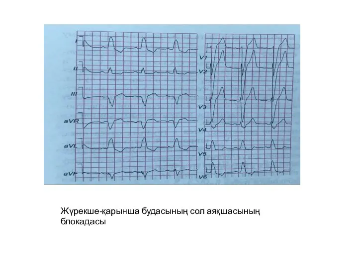 Жүрекше-қарынша будасының сол аяқшасының блокадасы