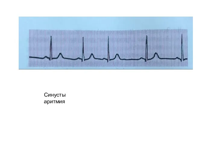 Синусты аритмия