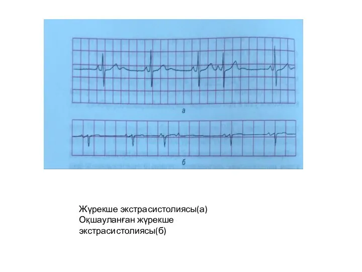 Жүрекше экстрасистолиясы(а) Оқшауланған жүрекше экстрасистолиясы(б)