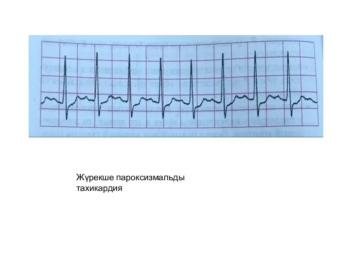 Жүрекше пароксизмальды тахикардия