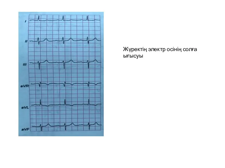 Жүректің электр осінің солға ығысуы