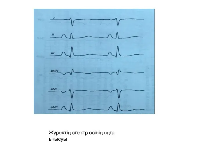 Жүректің электр осінің оңға ығысуы