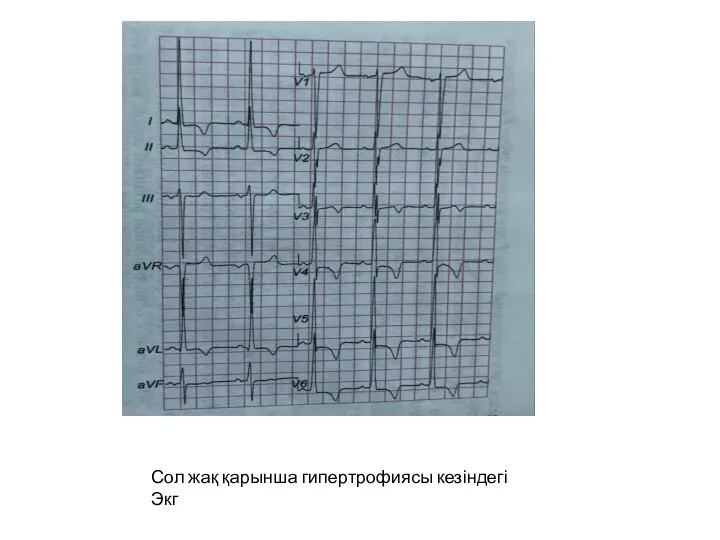 Сол жақ қарынша гипертрофиясы кезіндегі Экг