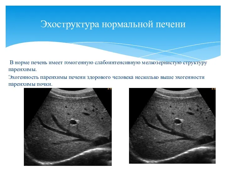 В норме печень имеет гомогенную слабоинтенсивную мелкозернистую структуру паренхимы. Эхогенность паренхимы печени