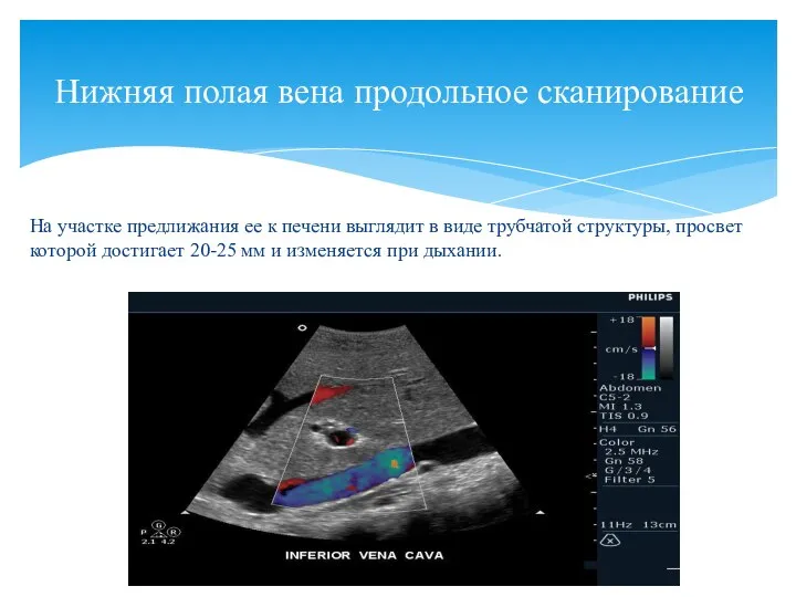 На участке предлижания ее к печени выглядит в виде трубчатой структуры, просвет