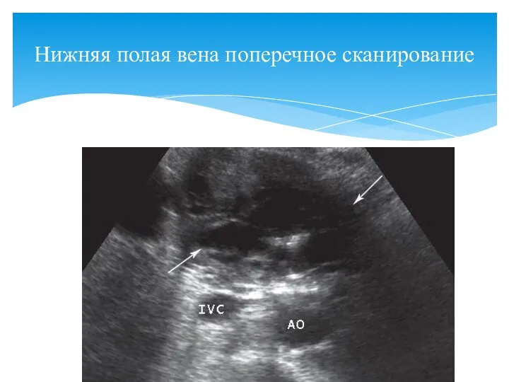 Нижняя полая вена поперечное сканирование