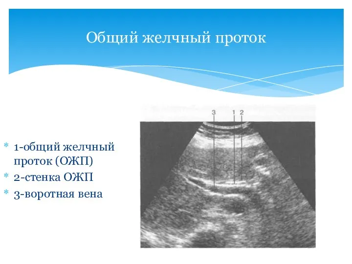 Общий желчный проток 1-общий желчный проток (ОЖП) 2-стенка ОЖП 3-воротная вена