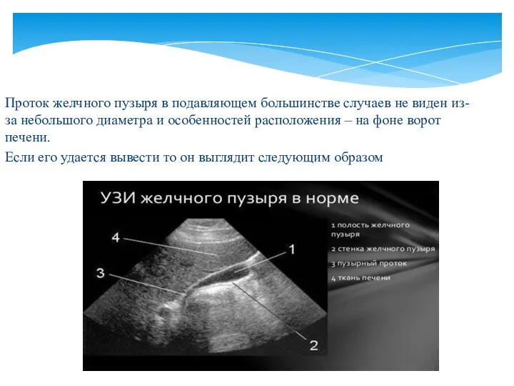 Проток желчного пузыря в подавляющем большинстве случаев не виден из-за небольшого диаметра