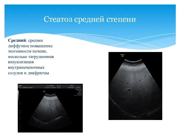 Стеатоз средней степени Средний: среднее диффузное повышение эхогенности печени, несколько затрудненная визуализация внутрипеченочных сосудов и диафрагмы