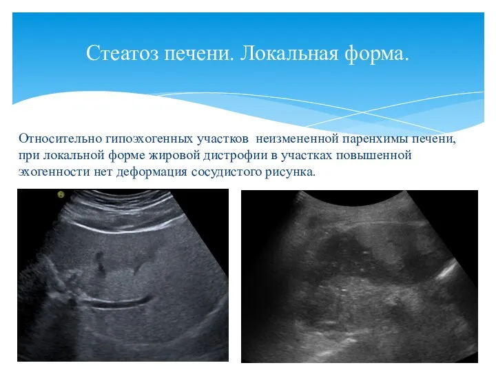 Относительно гипоэхогенных участков неизмененной паренхимы печени, при локальной форме жировой дистрофии в