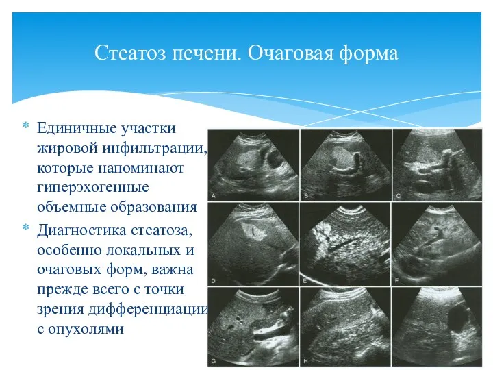 Единичные участки жировой инфильтрации, которые напоминают гиперэхогенные объемные образования Диагностика стеатоза, особенно