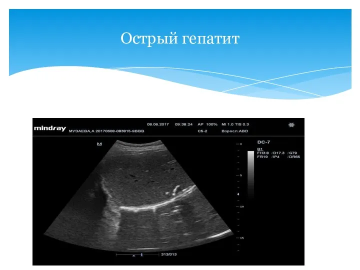 Острый гепатит
