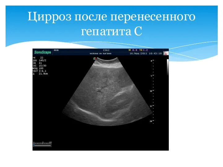 Цирроз после перенесенного гепатита С