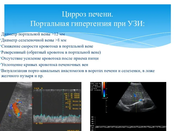 Диаметр портальной вены >12 мм Диаметр селезеночной вены >8 мм Снижение скорости