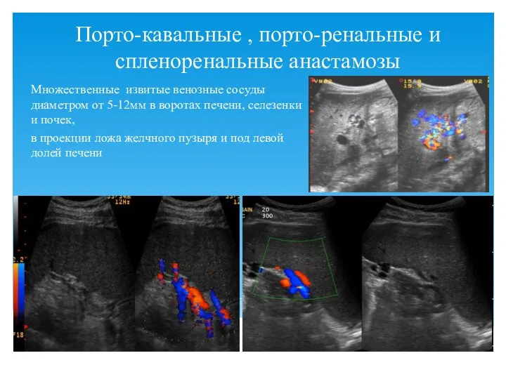 Порто-кавальные , порто-ренальные и спленоренальные анастамозы Множественные извитые венозные сосуды диаметром от