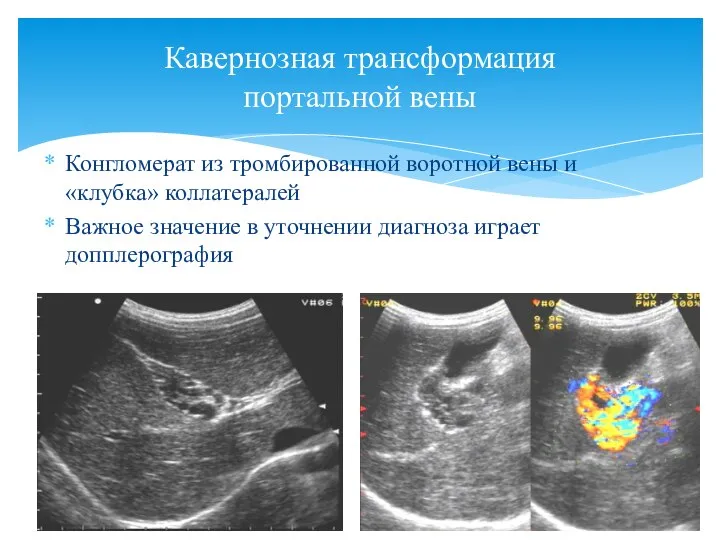 Конгломерат из тромбированной воротной вены и «клубка» коллатералей Важное значение в уточнении