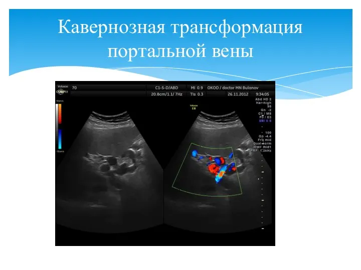 Кавернозная трансформация портальной вены