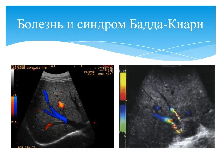 Болезнь и синдром Бадда-Киари