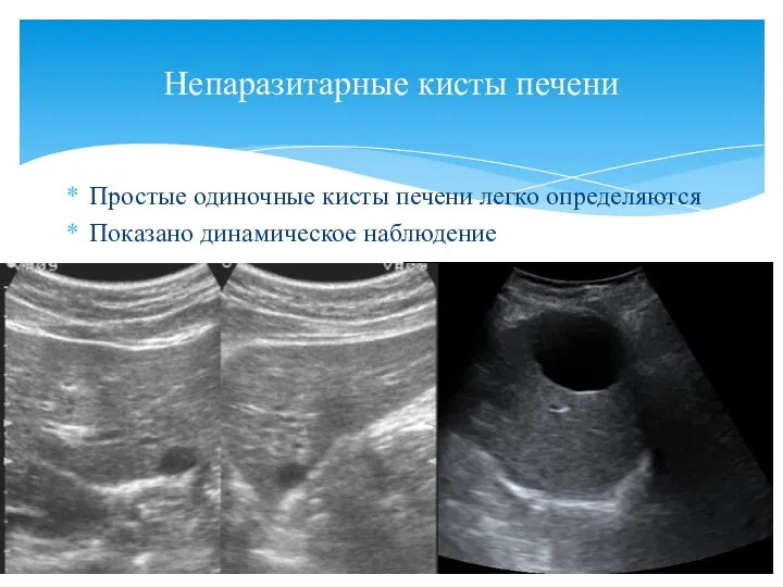 Простые одиночные кисты печени легко определяются Показано динамическое наблюдение Непаразитарные кисты печени