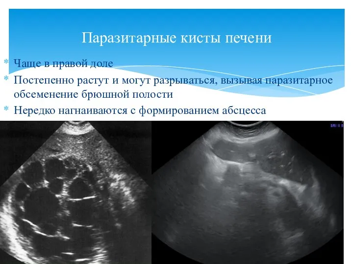 Чаще в правой доле Постепенно растут и могут разрываться, вызывая паразитарное обсеменение