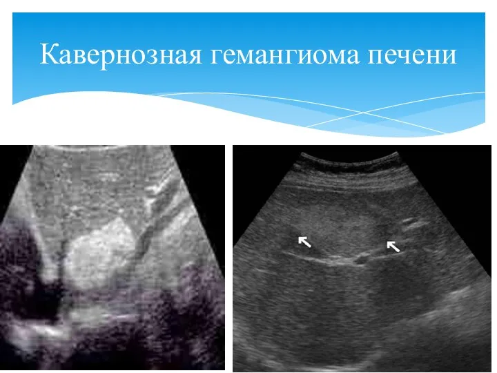 Кавернозная гемангиома печени