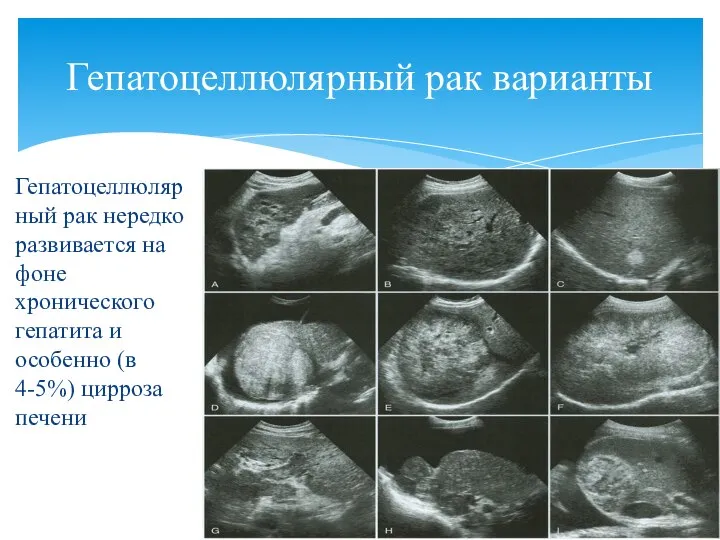 Гепатоцеллюлярный рак нередко развивается на фоне хронического гепатита и особенно (в 4-5%)