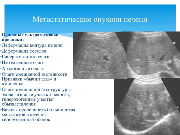 Основные ультразвуковые признаки: Деформация контура печени Деформация сосудов Гиперэхогенные очаги Изоэхогенные очаги