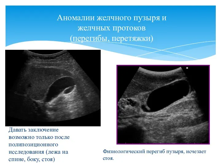 Давать заключение возможно только после полипозиционного исследования (лежа на спине, боку, стоя)