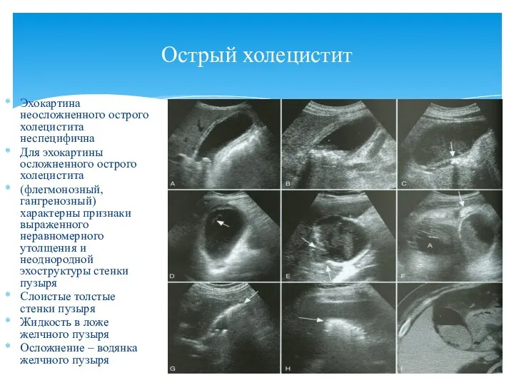 Эхокартина неосложненного острого холецистита неспецифична Для эхокартины осложненного острого холецистита (флегмонозный, гангренозный)