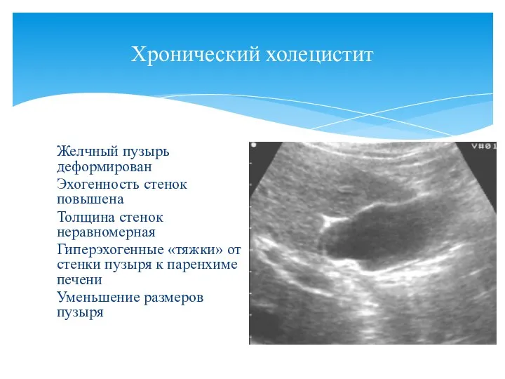 Хронический холецистит Желчный пузырь деформирован Эхогенность стенок повышена Толщина стенок неравномерная Гиперэхогенные