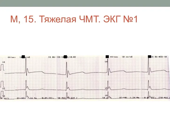 М, 15. Тяжелая ЧМТ. ЭКГ №1