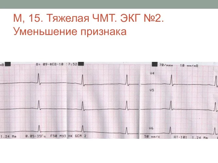 М, 15. Тяжелая ЧМТ. ЭКГ №2. Уменьшение признака